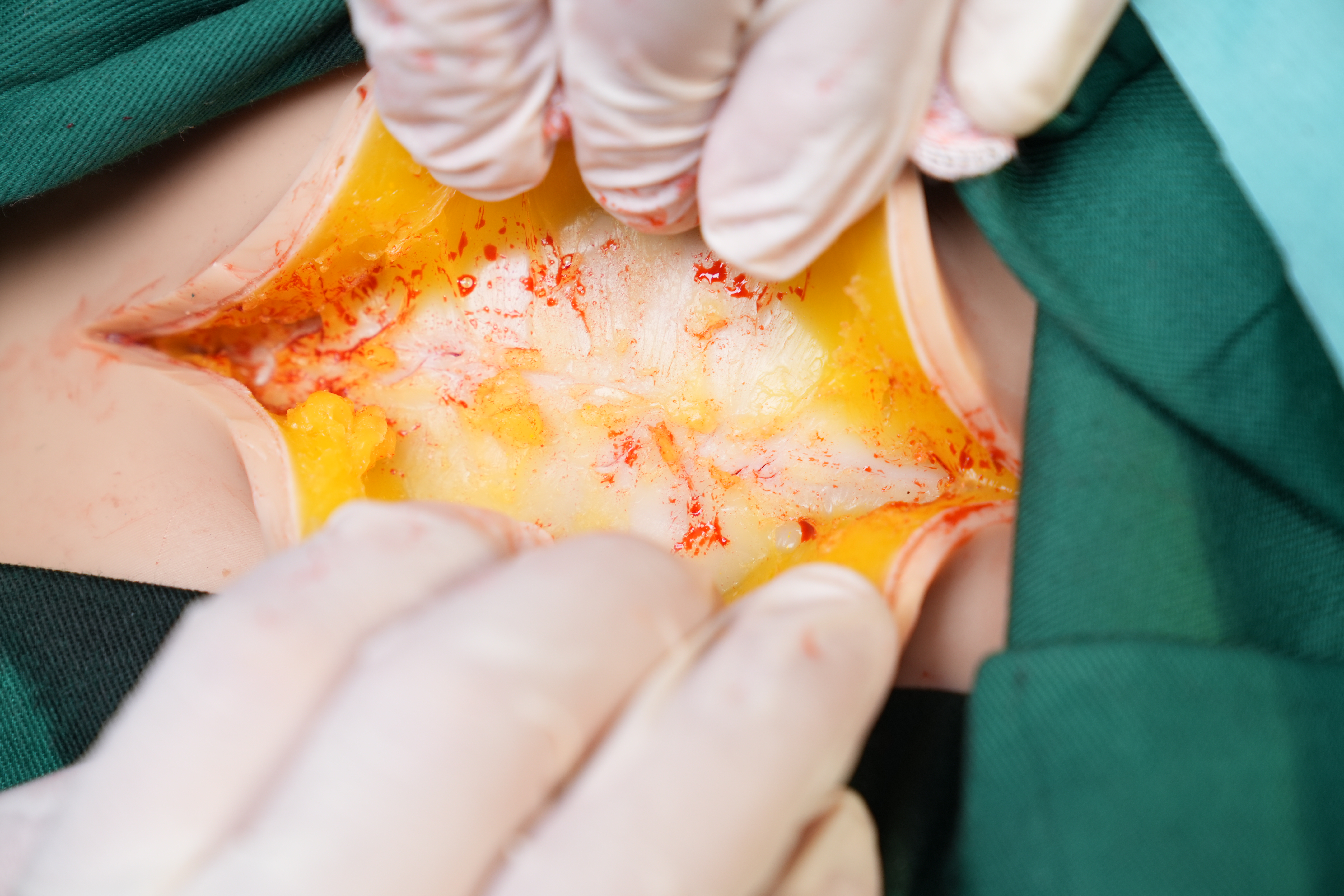 剖宫产手术平台 2.0